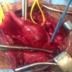 L'anévrisme aortique est une maladie de l'aorte consistant en une dilatation de cette dernière. Elle peut concerner n'importe quel segment de ce vaisseau. La forme la plus fréquente est l'anévrisme de l'aorte abdominale en dessous des artères rénales