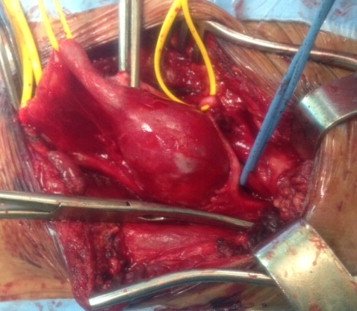 L'anévrisme aortique est une maladie de l'aorte consistant en une dilatation de cette dernière. Elle peut concerner n'importe quel segment de ce vaisseau. La forme la plus fréquente est l'anévrisme de l'aorte abdominale en dessous des artères rénales