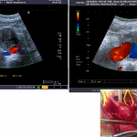 L'anévrisme aortique est une maladie de l'aorte consistant en une dilatation de cette dernière. Elle peut concerner n'importe quel segment de ce vaisseau. La forme la plus fréquente est l'anévrisme de l'aorte abdominale en dessous des artères rénales