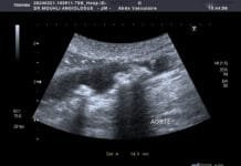 L’aorte : La plus grande artère du corps et les dangers de l’athérosclérose L’aorte est la plus grosse artère du corps. Partant du cœur, elle achemine le sang vers les jambes en passant par le thorax et l’abdomen. Elle décrit d’abord un trajet ascendant puis effectue un virage (crosse) où naissent les artères à destination des bras et du cerveau. Elle descend ensuite dans le thorax en vascularisant la moelle épinière. Une fois au niveau du diaphragme, elle devient l’aorte abdominale où le sang est distribué dans les artères du tube digestif (tronc cœliaque donnant les artères hépatique et splénique, artère mésentérique supérieure, artère mésentérique inférieure) et des reins. Les thromboses aortiques sont le plus souvent liées à la présence de lésions athéromateuses au sein de la paroi aortique chez des patients avec des facteurs de risques cardio-vasculaires. De rares cas surviennent sur artère saine et sont alors considérés comme « isolés ». L’athérosclérose est responsable de nombreuses maladies cardio-vasculaires qui représentent la première cause de mortalité dans le monde. QU’EST-CE QUE L’ATHÉROSCLÉROSE ? L’Athérosclérose ou artériosclérose correspond à un dépôt de graisses formant une plaque d’athérome qui rétrécit le passage du sang. QUELLES SONT LES CONSÉQUENCES DE L’ATHÉROSCLÉROSE ? Les conséquences de la plaque d’athérome sont multiples dont la rupture à l’origine d’accident vasculaire grave. L’athérosclérose peut toucher différents organes. Un rétrécissement d’aorte Un rétrécissement des artères carotides peut entraîner un accident vasculaire cérébral. En cas d’atteinte des artères des jambes, on parlera d’artériopathie oblitérante ou artérite des membres inférieurs. L’atteinte des artères coronaires peut entraîner des infarctus du myocarde. Le mode de révélation clinique de la thrombose Claudication fessiére ;pieds froids et absence de pouls périphérique Il s’agit du cas typique d’une patiente présentant une sténose de l’aorte abdominale sous-rénale (sténose de l’aorte basse) à extension iliaque, découverte à l’occasion de la persistance de douleurs dorsales à irradiation fessière. une ischémie aiguë de membre dans 8 cas sur 10. écho-Doppler artériel un scanner thoraco-abdominal injecté, Les cas survenant sur artère saine sont difficiles à dénombrer et le terme de thrombus « isolé » est peut-être employé par défaut. L'hypothèse d'une lésion athéromateuse focale isolée induisant un thrombus, ou des pathologies inflammatoires diagnostiquées sur l'examen anatomopathologique du thrombus l'illustrent. POURQUOI UN ÉCHODOPPLER ?