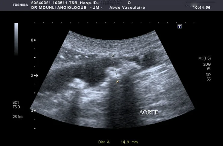 L’aorte est la plus grosse artère du corps. Partant du cœur, elle achemine le sang vers les jambes en passant par le thorax et l’abdomen. Elle décrit d’abord un trajet ascendant puis effectue un virage (crosse) où naissent les artères à destination des bras et du cerveau. Elle descend ensuite dans le thorax en vascularisant la moelle épinière. Une fois au niveau du diaphragme, elle devient l’aorte abdominale où le sang est distribué dans les artères du tube digestif (tronc cœliaque donnant les artères hépatique et splénique, artère mésentérique supérieure, artère mésentérique inférieure) et des reins. Les thromboses aortiques sont le plus souvent liées à la présence de lésions athéromateuses au sein de la paroi aortique chez des patients avec des facteurs de risques cardio-vasculaires. De rares cas surviennent sur artère saine et sont alors considérés comme « isolés ». L’athérosclérose est responsable de nombreuses maladies cardio-vasculaires qui représentent la première cause de mortalité dans le monde. QU’EST-CE QUE L’ATHÉROSCLÉROSE ? L’Athérosclérose ou artériosclérose correspond à un dépôt de graisses formant une plaque d’athérome qui rétrécit le passage du sang. QUELLES SONT LES CONSÉQUENCES DE L’ATHÉROSCLÉROSE ? Les conséquences de la plaque d’athérome sont multiples dont la rupture à l’origine d’accident vasculaire grave. L’athérosclérose peut toucher différents organes. Un rétrécissement d’aorte Un rétrécissement des artères carotides peut entraîner un accident vasculaire cérébral. En cas d’atteinte des artères des jambes, on parlera d’artériopathie oblitérante ou artérite des membres inférieurs. L’atteinte des artères coronaires peut entraîner des infarctus du myocarde. Le mode de révélation clinique de la thrombose Claudication fessiére ;pieds froids et absence de pouls périphérique Il s’agit du cas typique d’une patiente présentant une sténose de l’aorte abdominale sous-rénale (sténose de l’aorte basse) à extension iliaque, découverte à l’occasion de la persistance de douleurs dorsales à irradiation fessière. une ischémie aiguë de membre dans 8 cas sur 10. écho-Doppler artériel un scanner thoraco-abdominal injecté, Les cas survenant sur artère saine sont difficiles à dénombrer et le terme de thrombus « isolé » est peut-être employé par défaut. L'hypothèse d'une lésion athéromateuse focale isolée induisant un thrombus, ou des pathologies inflammatoires diagnostiquées sur l'examen anatomopathologique du thrombus l'illustrent. POURQUOI UN ÉCHODOPPLER ?