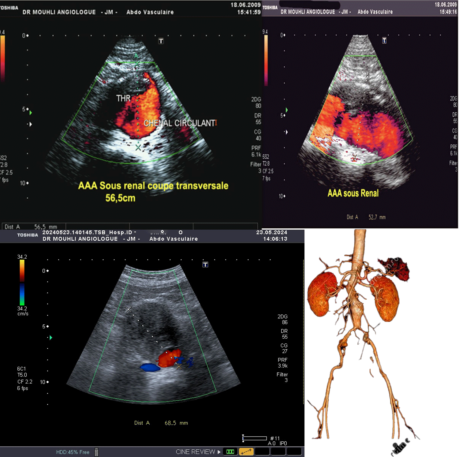 Qu’est-ce qu’un anévrisme ? C’est une dilatation anormale d’une artère due à une faiblesse de la paroi du vaisseau sanguin. Cette faiblesse peut entraîner la formation d’une poche ou d’une saillie, semblable à un ballon, dans la paroi de l’artère. Ces anomalies peuvent se former dans n’importe quelle artère du corps, mais ils sont plus courants dans l’aorte (la plus grande artère du corps) et dans celles du cerveau.