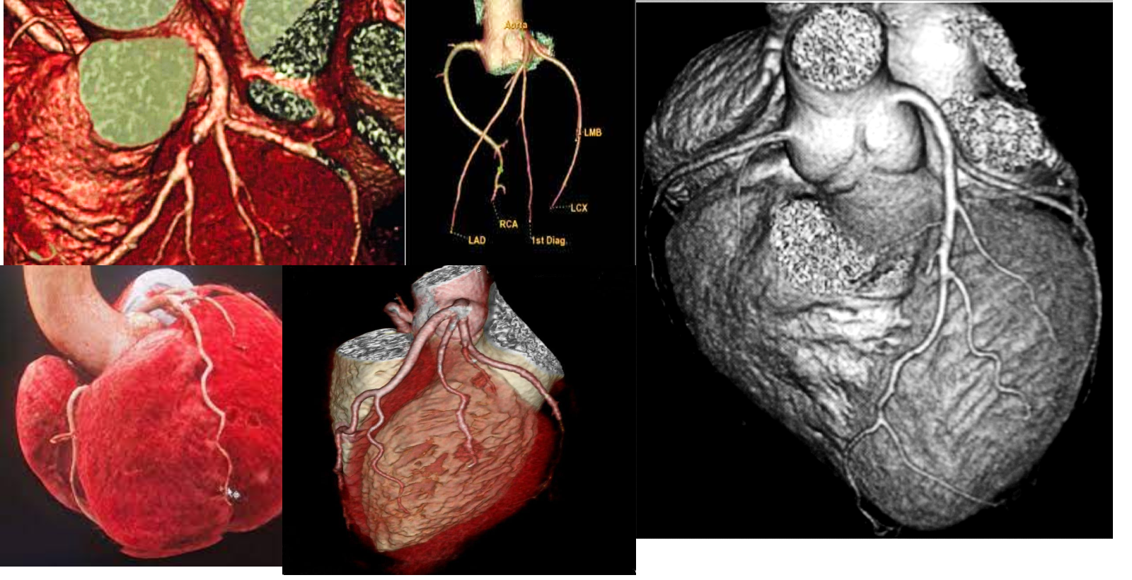 Le « coroscanner » (ou scanner cardiaque) est un examen d'imagerie médicale utilisant des rayons X pour visualiser le cœur et ses artères coronaires. Il permet de détecter des obstructions partielles ou complètes, des plaques d'athérome et d'évaluer le risque cardiovasculaire. L'examen implique une injection intraveineuse de produit de contraste iodé et une synchronisation avec l'électrocardiogramme pour obtenir des images nettes.